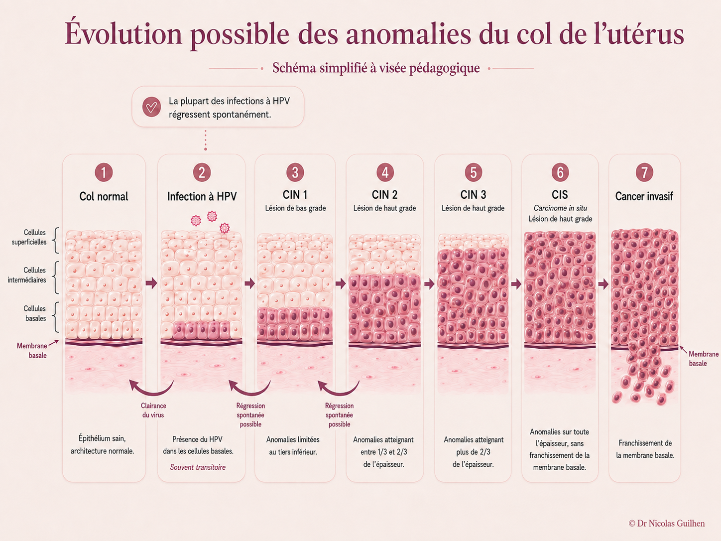 Évolution possible des anomalies du col de l’utérus : col normal, infection à HPV, CIN 1, CIN 2, CIN 3/CIS et cancer invasif, avec possibilités de clairance et de régression